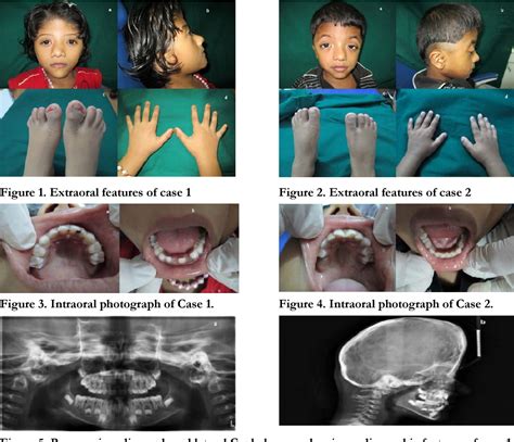 crouzon syndrome results in lower jaw figgerits answers|Pediatric Crouzon Syndrome .